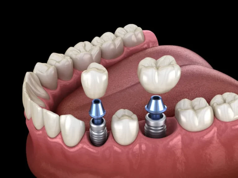 What Happens Before Dental Implants Are Installed?