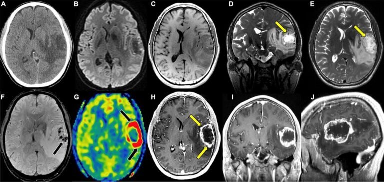 Brain Disorders