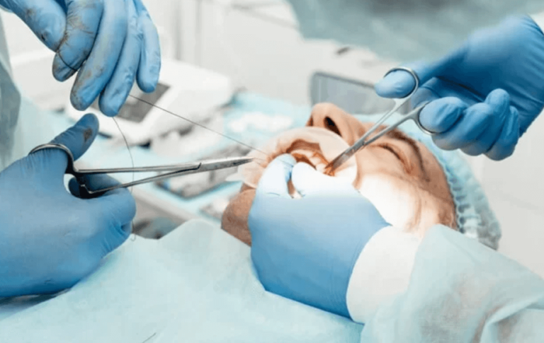 The Process of Getting Dental Implants Explained