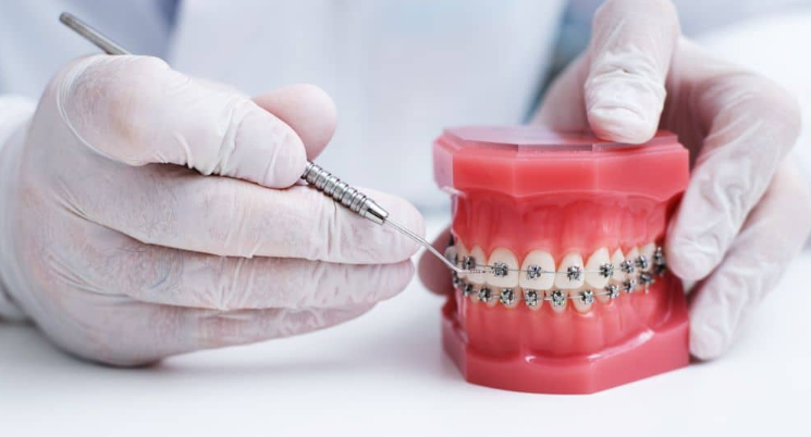 Common Teen Orthodontic Myths That Can Lead to Costly Mistakes Later