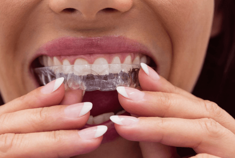 Why ‘Soft Smile Aesthetics’ Are Replacing Perfect Teeth And How Clear Aligners Fit In