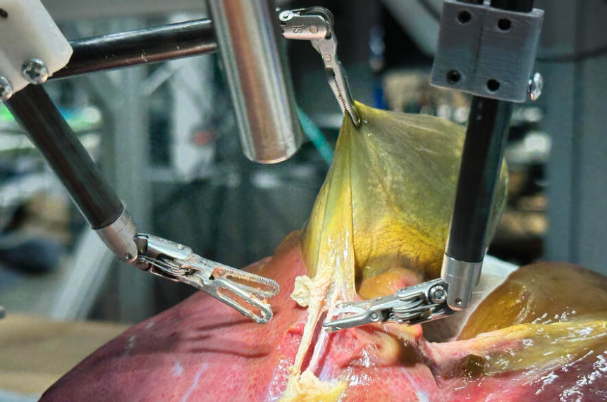 Laparoscopic Surgery: How Smarter Instruments Changed the Operating Room