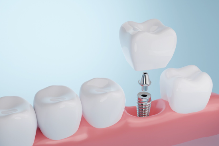 The Hidden Impact of Missing Teeth: How Dental Implants Can Support Better Oral Care and Everyday Confidence