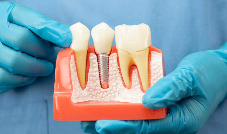What Are Dental Implants? Benefits, Types, and What to Expect